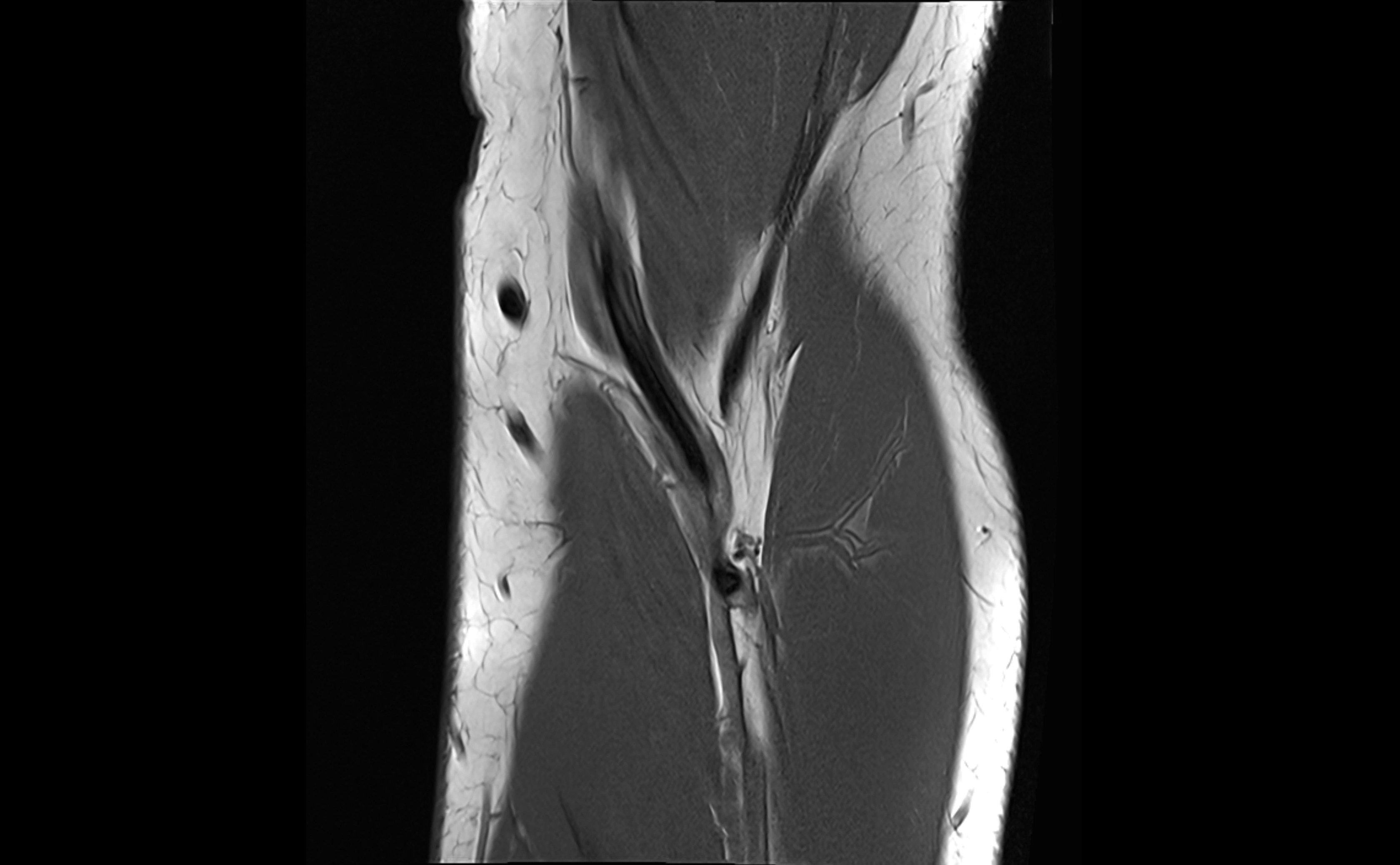 MRI elbow ligaments coronal cross sectional anatomy 3T  radiology  image-img-07001-00008.webp